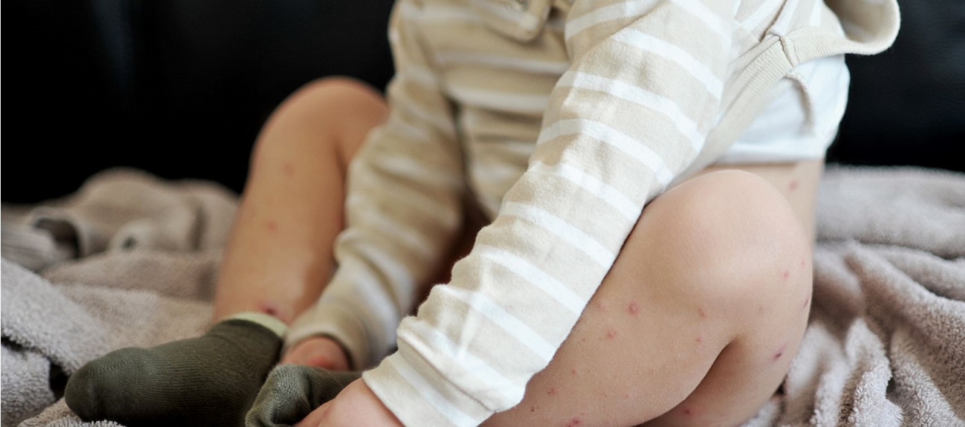 Die Beine eines Babys mit roten Pocken und trockenen Stellen. 